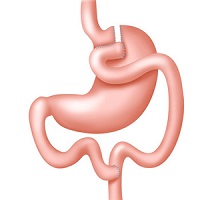 Vertical Sleeve Gastrectomy Treatment in Guntur, Best Bariatric Surgery Treatment in Guntur, Mini Gastric Bypass Treatment, Roux-En-Y Gastric Bypass Treatment in Guntur, Best Obesity Surgeon in Guntur, Weight Loss Surgery Treatment in Guntur